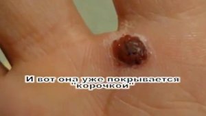 Как вывести бородавку горным чистотелом