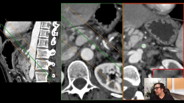 Вовлечение парапанкреатических сосудов аденокарциномой поджелудочной железы смотреть онлайн