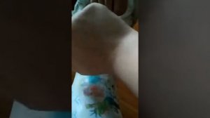 Нога в гипсе_18