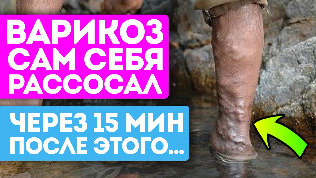 Закупорки, варикоз, тяжесть в ногах и даже отёчность исчезли! Должна знать каждая женщина