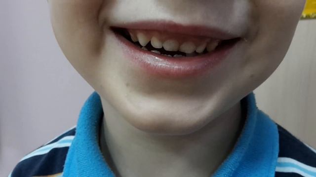 Короткая уздечка языка или короткая подъязычная уздечка.Нужно ли подрезать короткую уздечку? смотреть онлайн