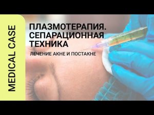 Плазмотерапия. Сепарационная техника.Лечение акне и постакне