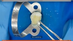 БАЗОВАЯ ЭНДОДОНТИЯ. Часть 11. BUILD-UP  со стекловолоконным штифтом, подготовка зуба к коронке.