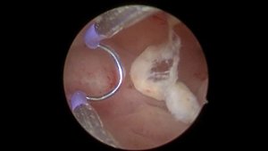 Полипоз цервикального канала, полипоз эндометрия