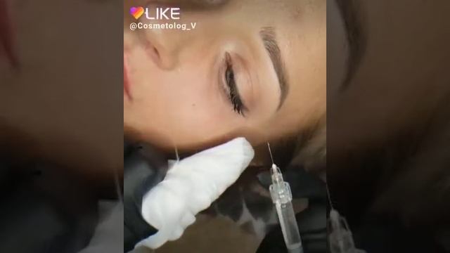 заполнение носослезной борозды смотреть онлайн