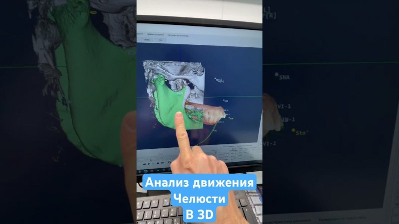 Анализ движения нижней челюсти в 3d. Аксиография, Стас Белоус Ульяновск