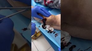 Гематома после травмы вскрытие