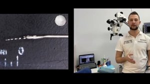 Извлечение сломанного инструмента из канала зуба , удаление инструмента из канала зуба , лечение зу