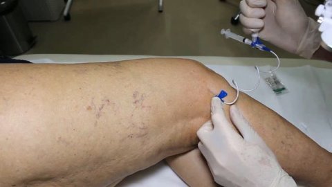 sclerotherapy склеротерапия
