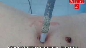 Удаление папилломы