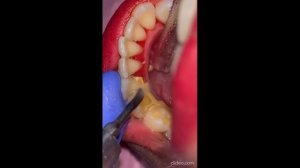 удаления зубного камня смотреть на ютуб _tartar removal watch on youtube