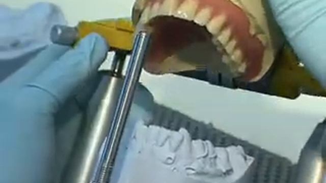Изготовление съёмного протеза с фиксацией на имплантах смотреть онлайн