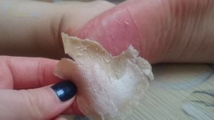 Мокрые (кровавые) мозоли: причины, симптомы, лечение, обработка, профилактика