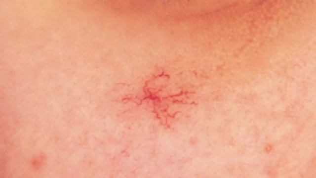 Бауыр циррозы су жиналу. Бауыр циррозы белгілері.