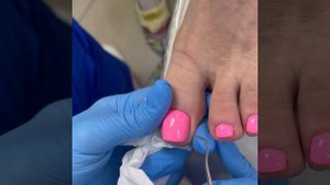 Удаление вросшего ногтя, без анестезии #вросшийноготь #подологсерпухов #подологмосква #курсыпедикюр