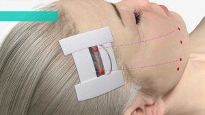 MINT LIFT – это первая рассасывающаяся лифтинговая нить из PDO для эффективной подтяжки лица