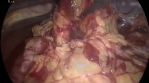 Splenectomia - operatore Francesco Ferrara