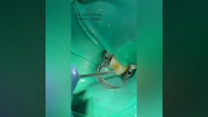 Пломбирование зубов