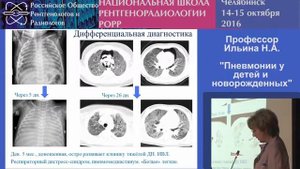Симптомы и лечение пневмонии у детей и новорожденных