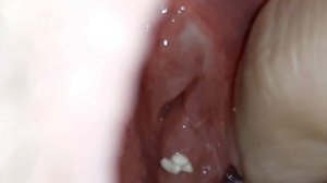 Удаление миндальных камней #3