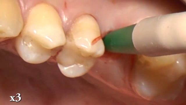 Easy internal sinus lift surgery смотреть онлайн