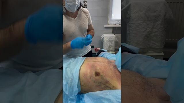 Коррекция гинекомастии у мужчин
