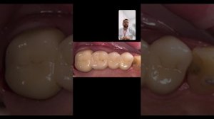 Мостовидный протез , или проще «мост» на зубы как говорят пациенты , протезирование зубов , зубы