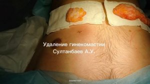 Удаление гинекомастии в Уфе