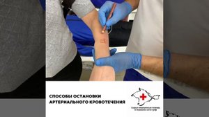 2. Способы остановки артериального кровотечения
