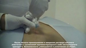 Блокада триггерных точек Trigger Point Injection 