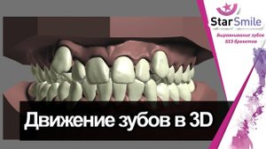 Виртуальный сетап (моделирование улыбки для элайнеров)★Star Smile★