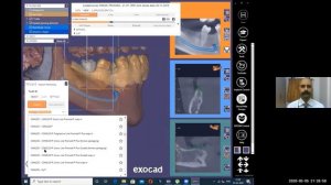 3D printed surgical guides  - Planning to Execution ll Webinar 2 ll DC Academia ll INsight CBCT