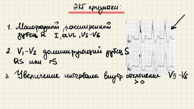 Блокада правой и левой ножек пучка Гиса. ЭКГ диагностика. Двухпучковая, трехпучковая блокады. смотреть онлайн