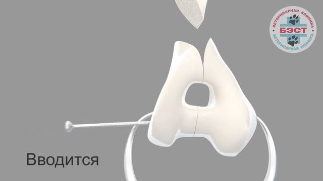 Фиксация полного внутрисуставного перелома дистального сегмента плечевой кости смотреть онлайн