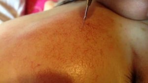 Удаление сосудистых звёздочек на лице