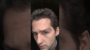 4,5 МЕСЯЦА ПОСЛЕ ПЕРЕСАДКИ ВОЛОС В МОСКВЕ.