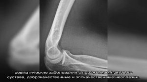 Рентген локтевого сустава в Москве