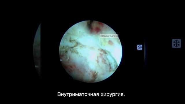 Внутриматочная хирургия. Гистерорезектоскопия.