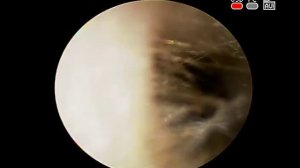 Отоскопия. Рецидивирующий хронический #грибковый средний #отит , #отомикоз, КЛИНИКА ОБРАЗЦОВА