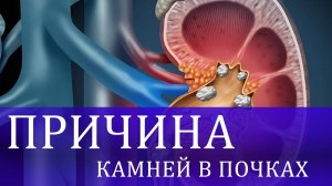 Главная причина камней в почках.