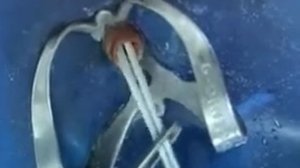 Технология фиксации штифтов