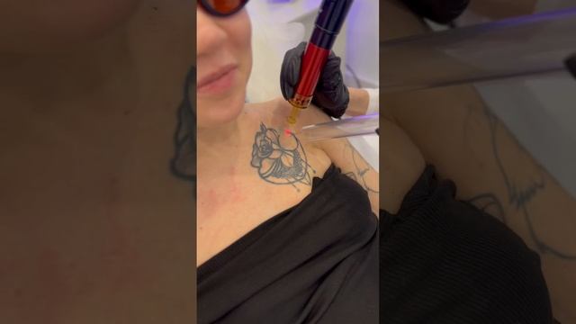 Удаление татуировки в клинике смотреть онлайн