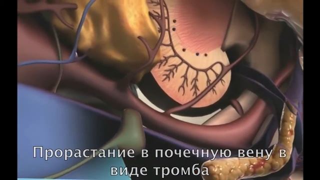 Возникновение рака почки смотреть онлайн