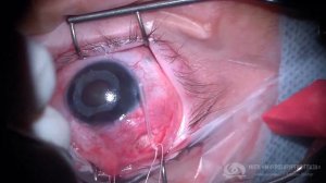 Имплантация клапана Ахмеда при глаукоме Франк-Каменецкого