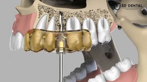 3D Dental шаблоны хирургические