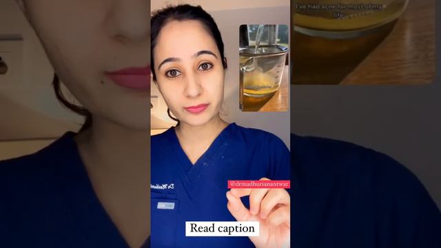 Ginger tea 🍵 for pimples|health drink for acne|acne health drink #acnesolutions #pimplesolution
