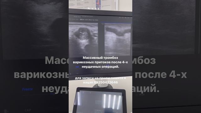 Тромбоз вен. Тромбофлебит. Варикоз на ногах. Как лечить тромбы. Флеболог Москва. Флеболог смотреть онлайн