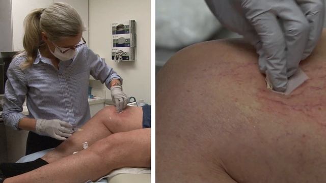 Sclerotherapy procedure for spider veins.
