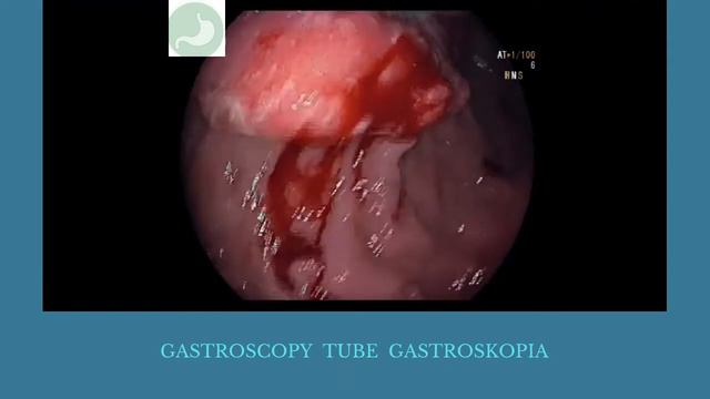 CASE3 guz żołądka смотреть онлайн