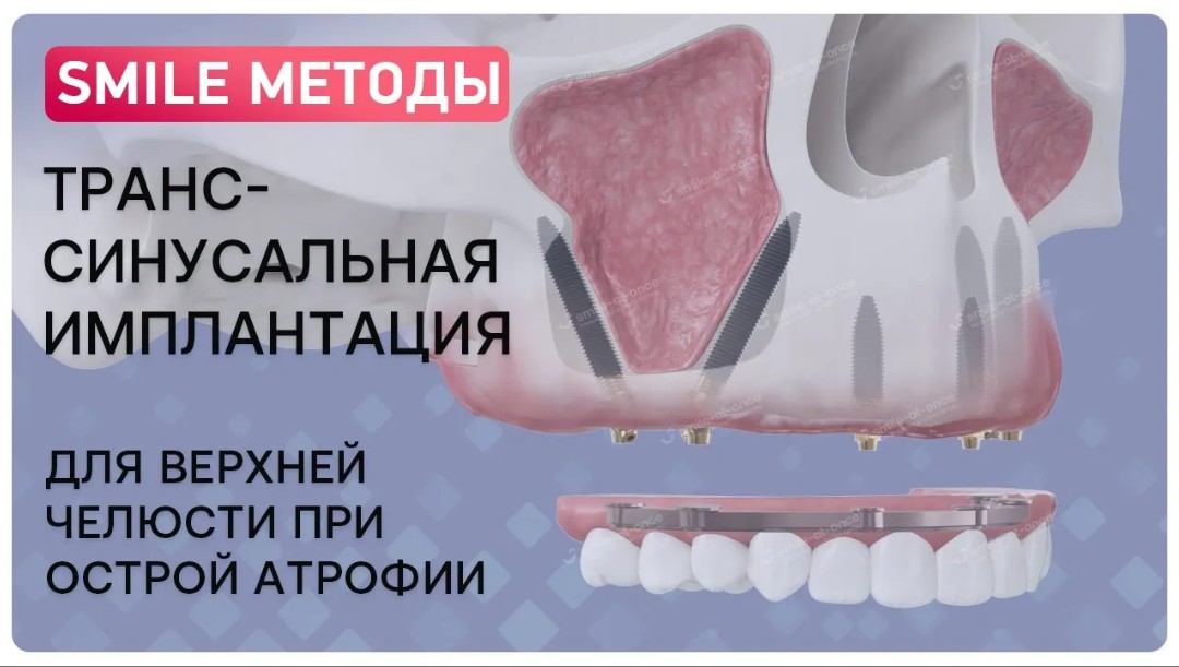 Имплантация гродно. Транссинусальная имплантация. Транссинусальная установка имплантата. Транссинусальная установка импланта.